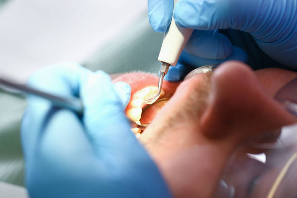 Best Emergency Wisdom Tooth Extraction in Oak Grove, LA